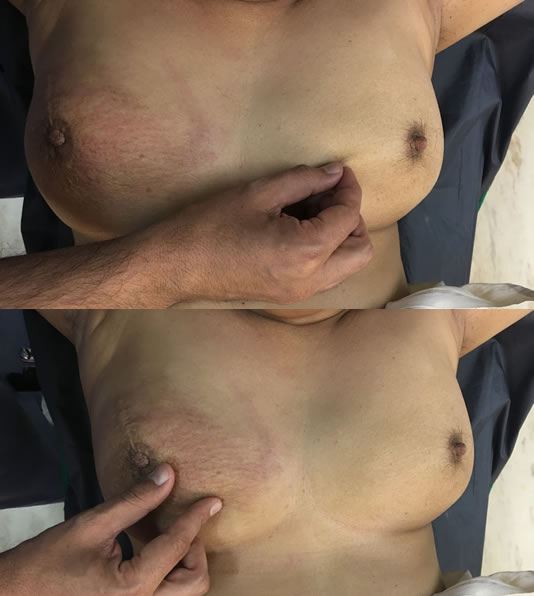 Mammography for breast lumps