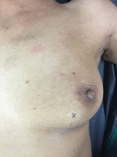 Mammography for breast lumps