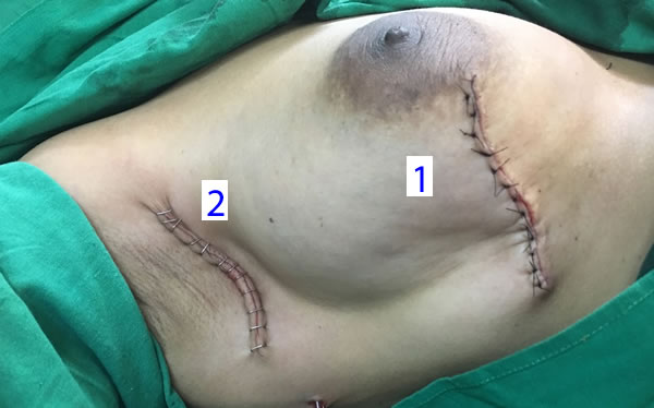Breast Conserving Surgery post surgery scar.