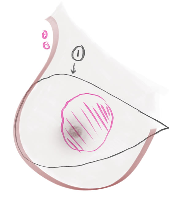 Mastectomy tumour and marking of surgery