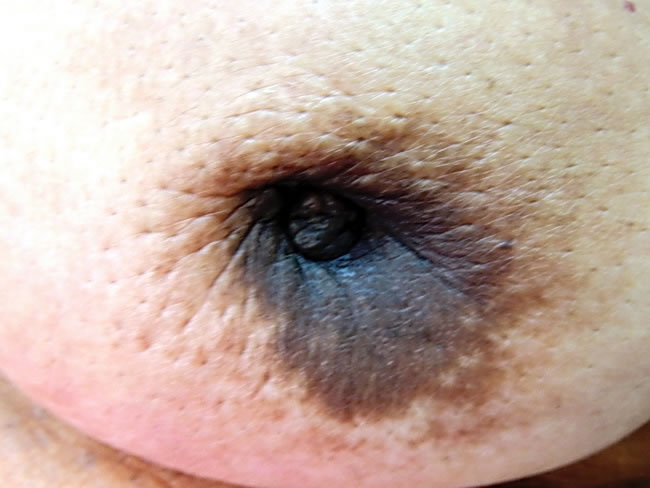 Nipple Retraction