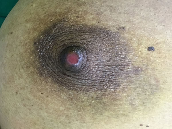 Nipple Ulcer